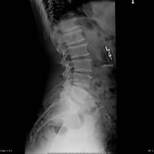 X-Ray Spine